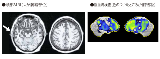 認知症ではどのような診察、検査をうけますか？